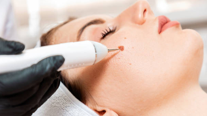 Skin tag and mole removal