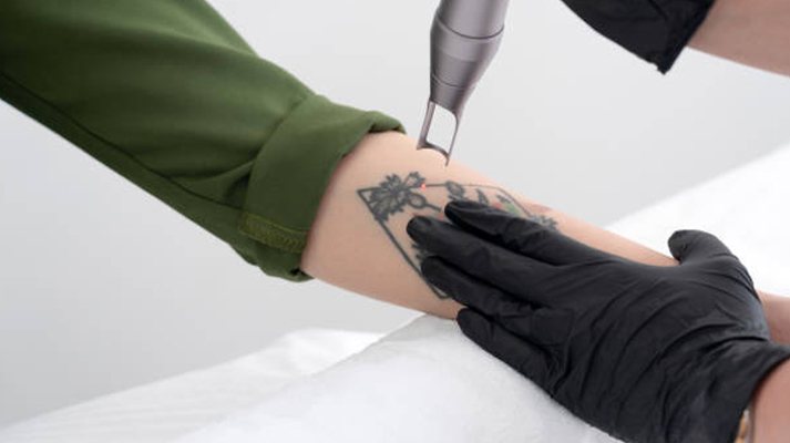 Tattoo Removal